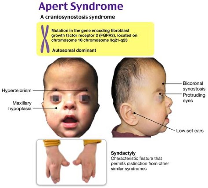 Does Brian Peppers Have Apert Syndrome? Convicted Sex Offender Whose Mugshot Went Viral In 2005