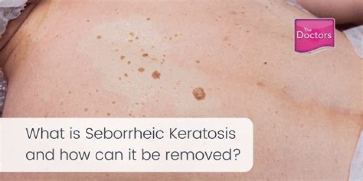 How to remove seborrheic keratosis