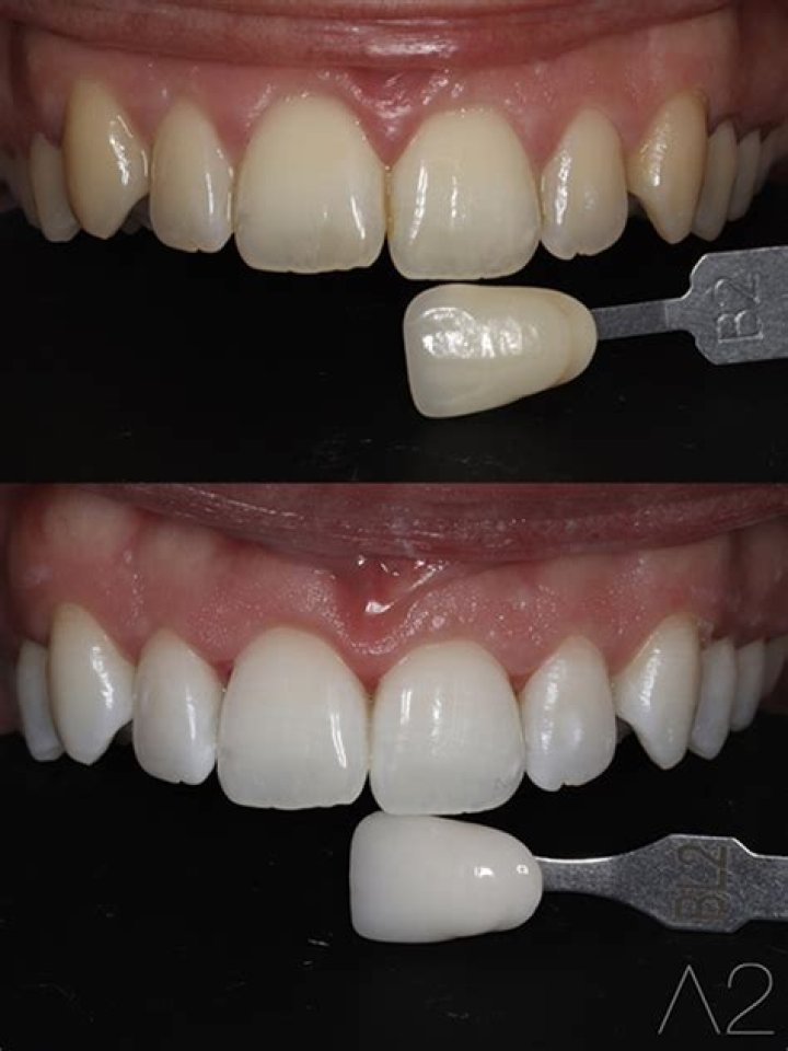 Is a2 a good tooth color