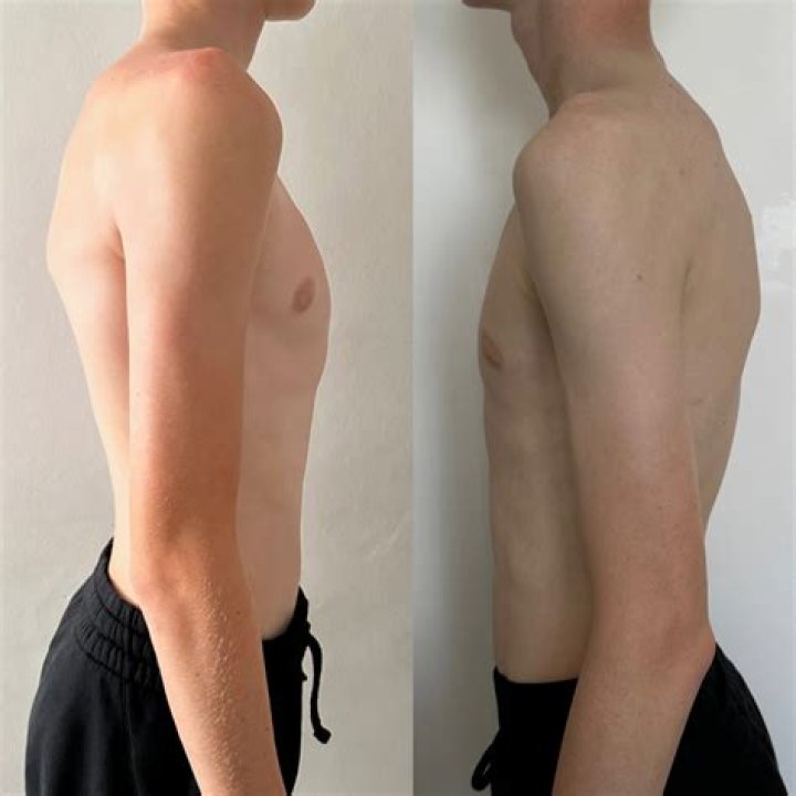 What Happened To Steven Crowder? His Health And Pectus Surgery Update